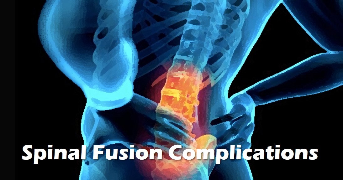 spinal fusion complications long term