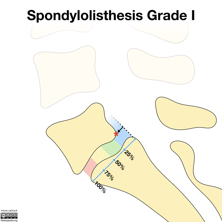 spondylolisthesis recovery