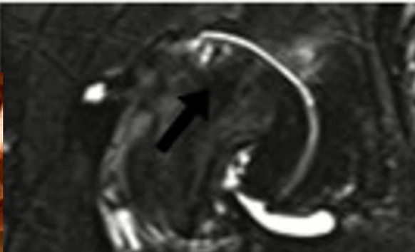 avascular necrosis staging - mri of stage 4