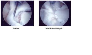 Surgical Repair of Labrum