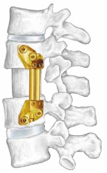 synes vertebral implant