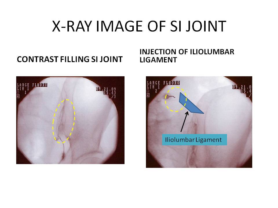 X-RAY IMAGE OF SI JOINT