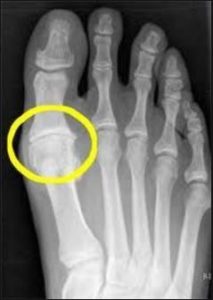 https://centenoschultz.com/wp-content/uploads/x-ray-of-bone-spur-on-first-toe-213x300.jpg